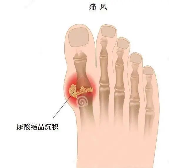 痛風(fēng)為什么偏愛男性？你最關(guān)心的問題都在這里