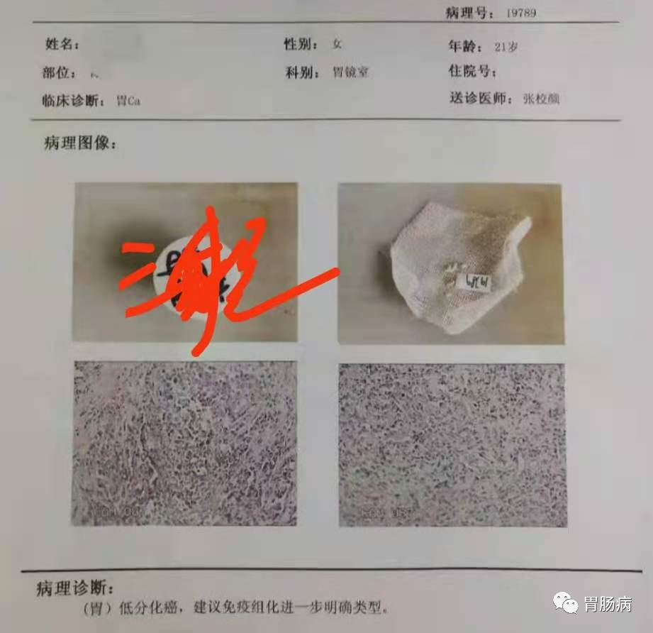 醫(yī)生總結(jié)了3位年輕胃癌患者的病例：30歲不到的他們到底干啥了？