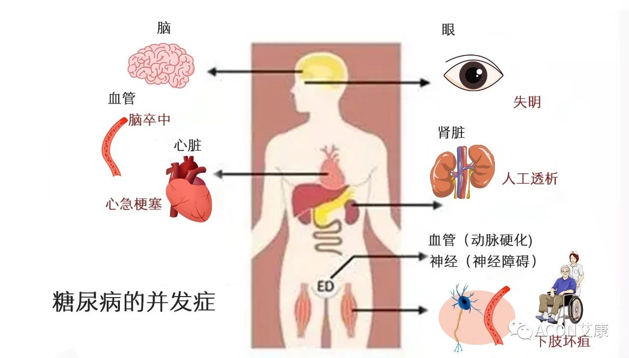 爆上熱搜，因爆發(fā)型糖尿病進入ICU，有哪些教訓值得我們汲取