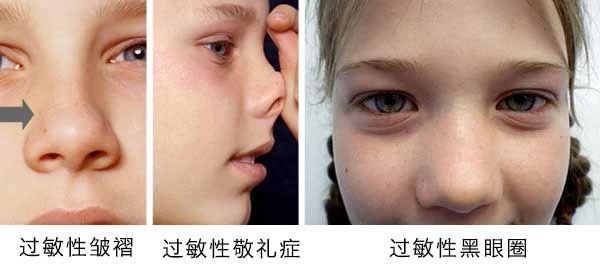 過敏性鼻炎會(huì)讓孩子變傻？！家長該如何應(yīng)對(duì)